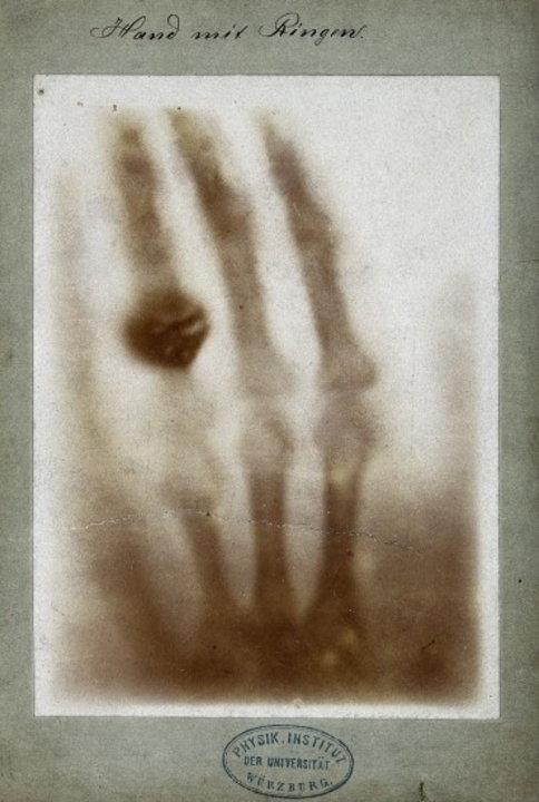 Hand with rings: a print of one of the first of Wilhelm Röntgen's X-ray photographs
