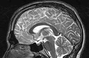MRI-bild av hjärna