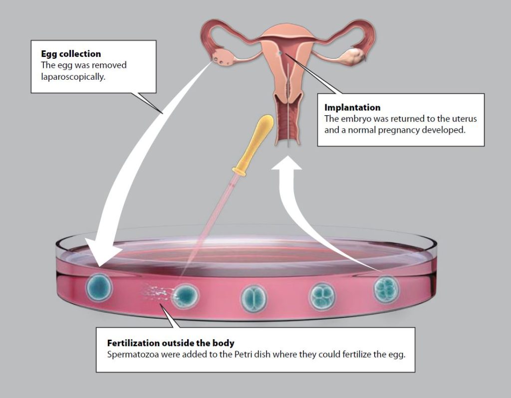 Drawing of the IVF process
