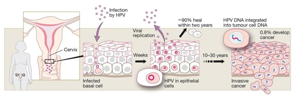 Illustration of cervical HPV infection and events that lead to progression to cervical cancer