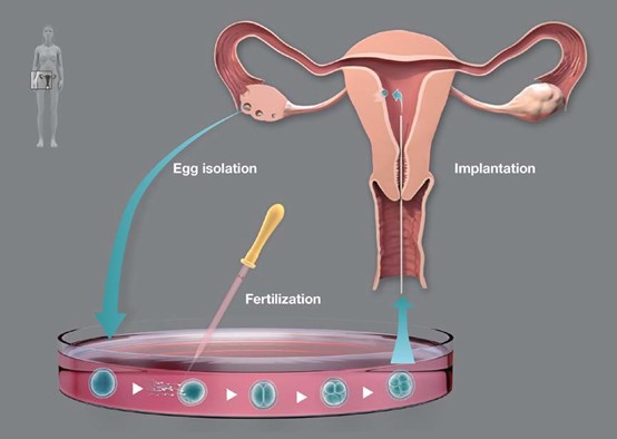 Illustration of the principle for IVF as developed by Edwards